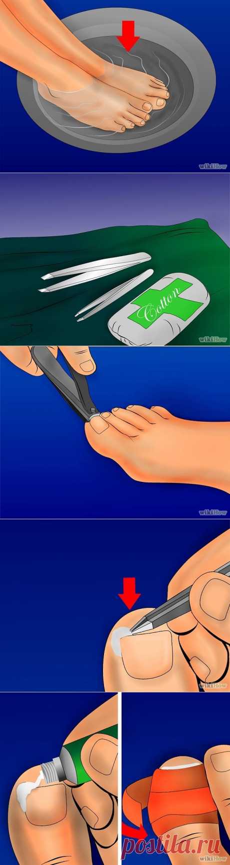 3 способа избавиться от вросшего ногтя - Wikihow