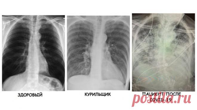 Врач сравнила рентген-снимки здорового, курильщика и больного коронавирусной инфекцией