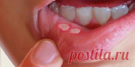 Стоматит ротовой полости: вот как избавиться от него народным методом за считанные минуты, без каких-либо медикаментов!