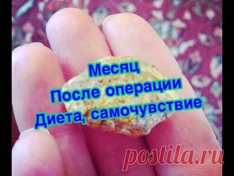 Месяц после удаления. Диета. Образ жизни. Осложнения