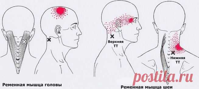 Карта триггеров: точки боли и точки напряжения мышц