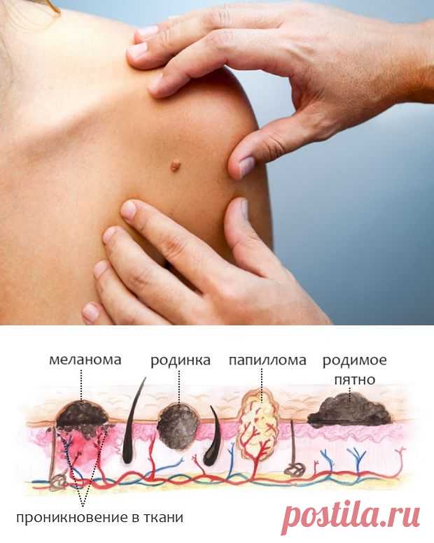 Как отличить родинку от папилломы
