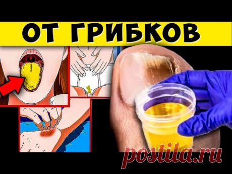 Избавьтесь от Грибка раз и навсегда! Супер Чистка от Кандиды, Паразитов и Грибков. Не кормите их...