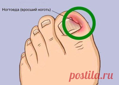 Как правильно решить проблему вросших ногтей и что такое ногтоеда?