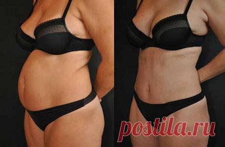 20 применений домашнего средства, и жир на животе тает на глазах – рецепт моей бабули

Всю жизнь жирный живот был большой моей проблемой. Что я только не делала, чтобы похудеть. Я сидела на диетах, занималась спортом. Вес уменьшался, но на животе это не отразилось никак. Все дошло до того, что я задумалась об операциях.