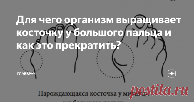 Для чего организм выращивает косточку у большого пальца и как это прекратить? Косточка у большого пальца (hallux valgus) - это компенсатор. Косточку выращивает сам организм. Для чего организм выращивает косточку, и как он это делает?
Для нормальной работы опорно-двигательного аппарата необходима полная стопа. Инженерия стопы в том, чтобы соединяться с поверхностью земли не только через зоны плотности, такие как пятка, подушечки пальцев и подушечки под пальцами, а и через