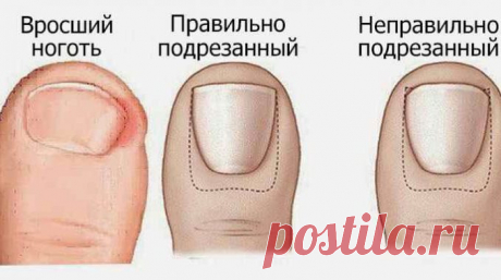 Натуральное домашнее средство для лечения вросших ногтей на ногах.Стоит попробовать! 
Вросшие ногти возникают, когда ноготь входит в мягкие ткани, а не из них. Самый распространенный случай — большой палец, у вас может быть болезненная и опухшая красная область, чувствительная к прико…