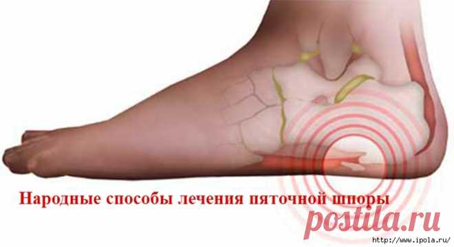 Народные способы лечения пяточной шпоры