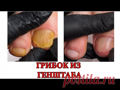 В БЕСПЛАТНЫХ КЛИНИКАХ ТОЖЕ ОЧЕНЬ ЛЮБЯТ ДРАТЬ ЗДОРОВЫЕ НОГТИ! Автор - ЕЛЕНА ДЗЫК
