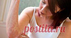 Дерматит кожи головы, лица, рук, ног - лечение, причины, симптомы