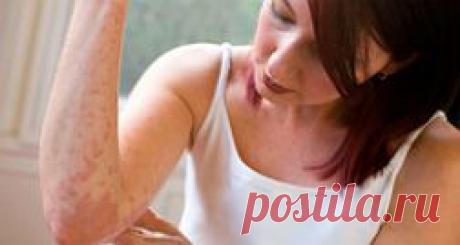 Дерматит кожи головы, лица, рук, ног - лечение, причины, симптомы