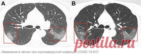 Коронавирусная инфекция: симптомы, лечение, вакцина в статье инфекциониста Александрова П. А.