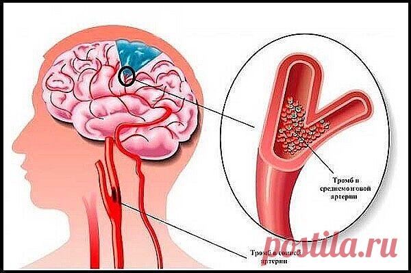 5 рецептов очищения сосудов головного мозга