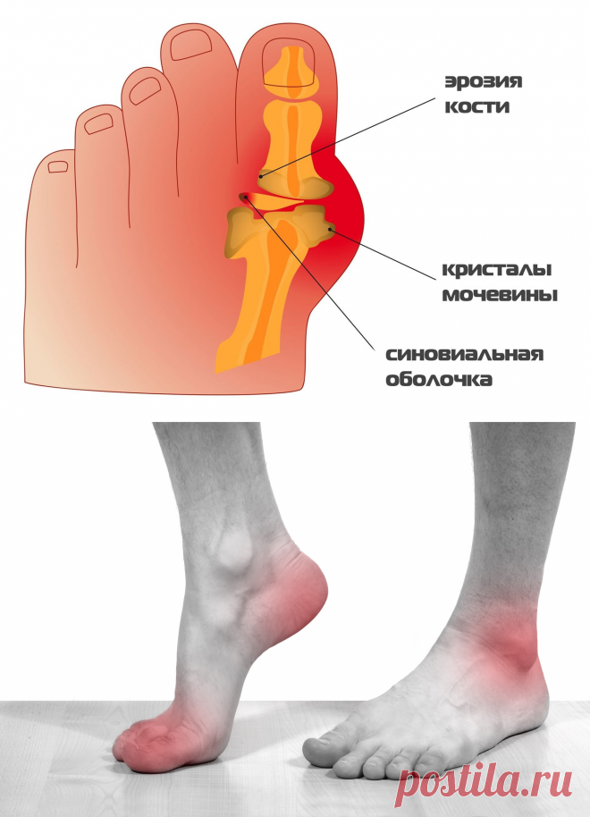 Подагра - лечение болезни. Симптомы и профилактика заболевания Подагра