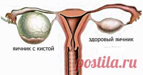 Что такое киста яичника | Домохозяйки