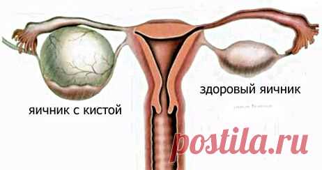 Что такое киста яичника | Домохозяйки