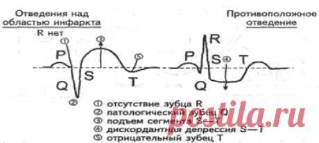 • ЭКГ признаки инфаркта миокарда - Шпаргалки для "скорой помощи"