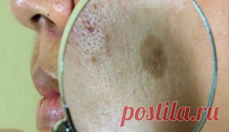 Это средство поможет удалить пигментные пятна на лице