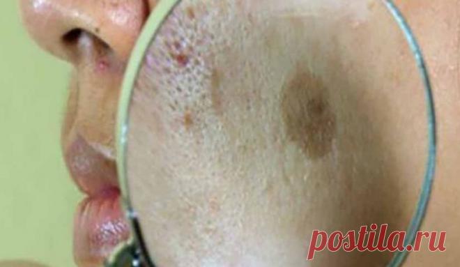 Это средство поможет удалить пигментные пятна на лице