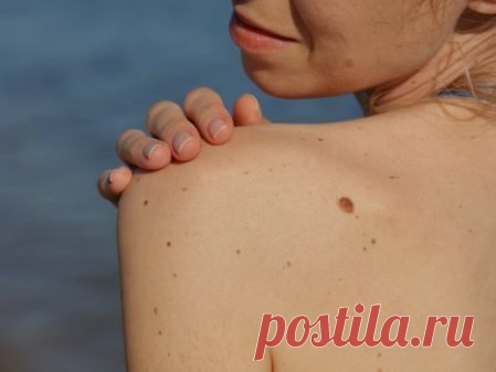 Почему появляются родинки на теле? | APochemu.ru | Яндекс Дзен