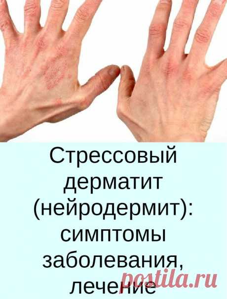 Стрессовый дерматит (нейродермит): симптомы заболевания, лечение