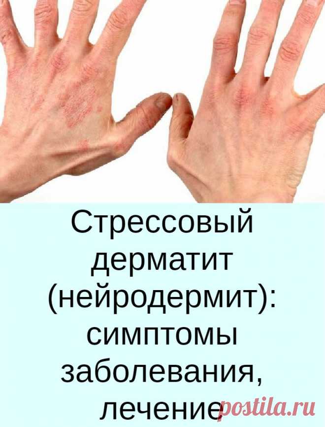 Стрессовый дерматит (нейродермит): симптомы заболевания, лечение