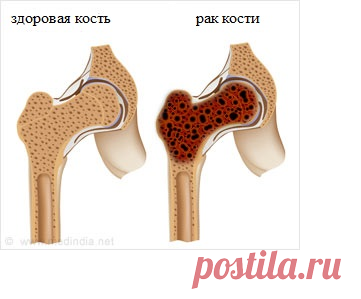 Рак костей