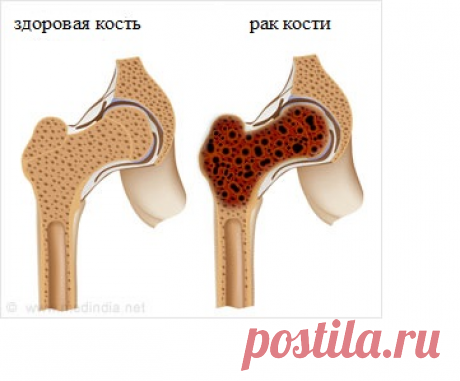 Рак костей
