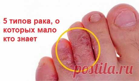 5 типов рака, о которых мало кто знает