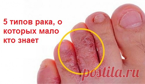 5 типов рака, о которых мало кто знает