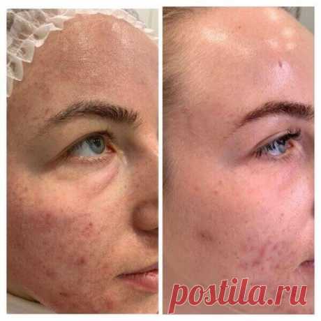 Убрать синяки под глазами под глазами в Киеве - Coolaser Clinic