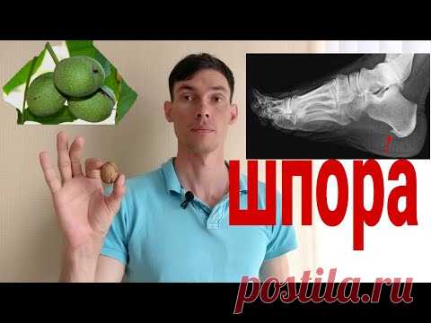 Пяточная ШПОРА убрать легко