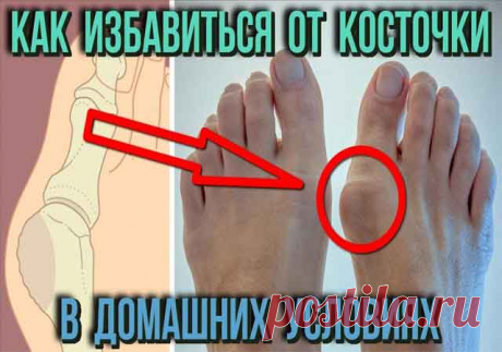 Трансдермальный магнитный пластырь доставляет вещества прямо на пораженный участок. Такой пластырь имеет несколько слоев: первый сохраняет лекарственный препарат, второй содержит лечащее вещество и нетоксичный клеящий состав. Благодаря инфракрасному и магнитному излучению экстракты трав быстро впитываются в кожу. Пластырь оказывает противовоспалительный и обезболивающий эффект, улучшает кровообращение и останавливает деформацию.