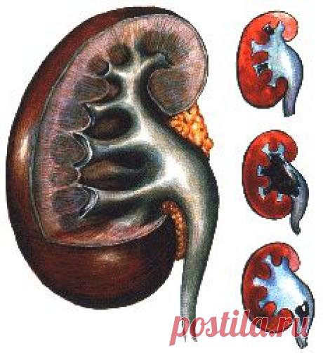 Камни в почках: симптомы камней в почках, причины камней в почках и диета