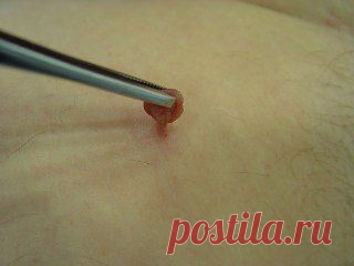 Папилломы. Полипы. Аденоиды.