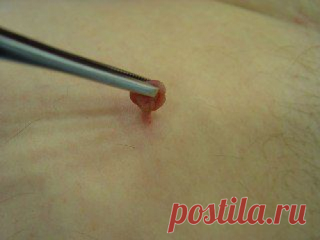 Папилломы. Полипы. Аденоиды.