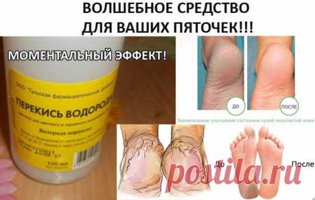 КОПЕЕЧНОЕ СРЕДСТВО ДЛЯ УХОДА ЗА ПЯТКАМИ 
Эффект потрясающий!!! Попробуйте и убедитесь сами!

Уже через несколько минут создаётся такое впечатление, что вы парили ноги по крайней мере полчаса. Вы сами почувствуете эффект, когда потрёте нога об ногу, как они "скрипят" от чистоты. Итак, берём небольшую мисочку (такого размера, чтобы только поместились в неё ноги), наливаем 1,5 литра воды, чтобы была горяченькая, но не очень. Добавляем в воду 4 столовых ложки перекиси водорода...