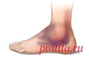 Отек голеностопного сустава лечение