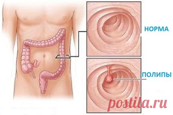 Полипы в кишечнике: признаки, симптомы, лечение у взрослых