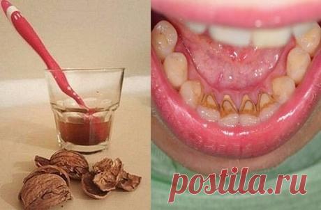 Как избавиться от зубного камня при помощи 1 простого средства.

Коричневый или желтый налет на зубах можно удалить дома! Зубной камень — распространенная проблема, и современная стоматология предлагает множество способов его устранения. Но существует метод, который работает не хуже, при этом экономя твои средства!

ТЕБЕ ПОНАДОБИТСЯ
40 г скорлупы грецких орехов
1 ст. воды

ПРИМЕНЕНИЕ
Отвари скорлупу в воде в течение 20 минут. Процеди смесь после того, как она остынет.
Замо...