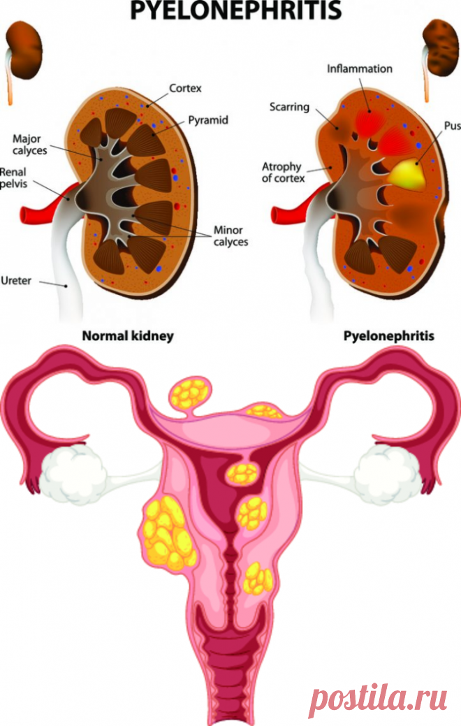 Частое мочеиспускание у женщин: причины и лечение