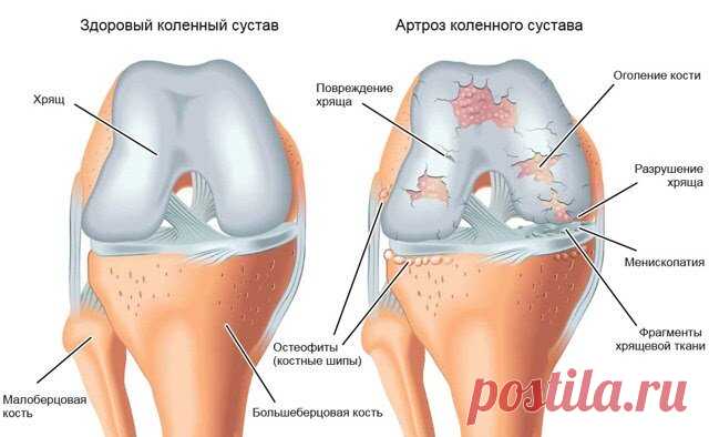 Артроз: причины болезни и факты, которые нужно знать каждому | Медицинский центр Е.В. Малышевой | Яндекс Дзен