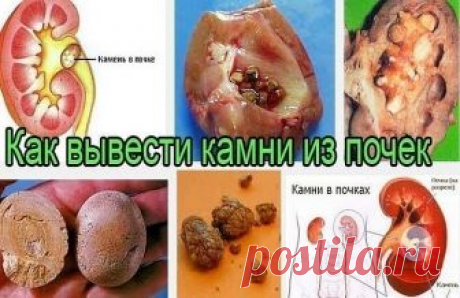 СРЕДСТВО ОТ КАМНЕЙ В ПОЧКАХ И В ЖЕЛЧНОМ ПУЗЫРЕ
	
1 ч. ложку семян моркови залить 1 стаканом воды, довести до кипения и варить на малом огне 10 минут. Настаивать 30-40 минут, процедить. Пить теплым по 1/2 стакана 3-4 раза в день. Курс лечения – месяц. 

После недельного перерыва повторить.

Знахарское средство от камней в печени и почках
	
Пропустить через мясорубку один стакан конопляного семени, смешать с тремя стаканами сырого молока и уварить до одного стакана. Горячим ...