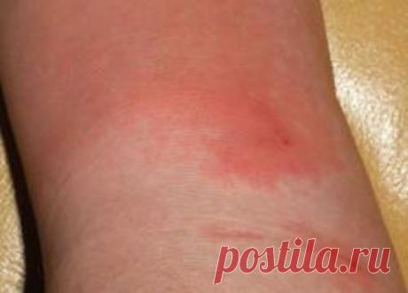 Народные средства лечения пролежней