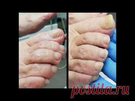 Медицинский аппаратный педикюр. Грибок. Выезд на дом.
