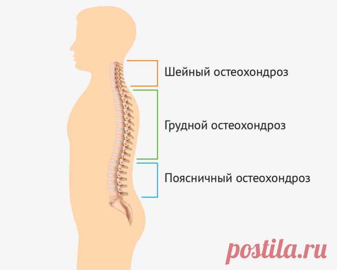 Беспредел бездействия, или Законы остеохондроза