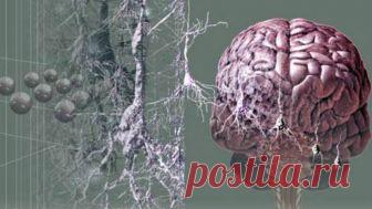 Кому грозит СТАРЧЕСКОЕ СЛАБОУМИЕ Академик Бехтерев, тот самый, что посвятил жизнь изучению мозга, как-то заметил, что великое счастье умереть, не растеряв