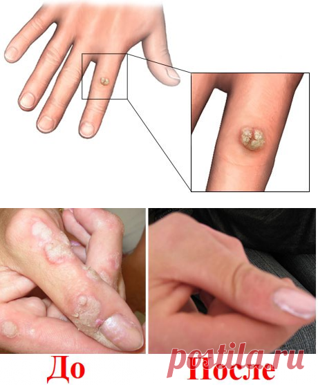 Как избавиться от бородавок на руках и пальцах: чем вывести бородавки?