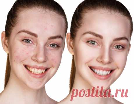 Вечерняя обработка прыщей листьями базилика и маслом эвкалипта - Полезные советы красоты