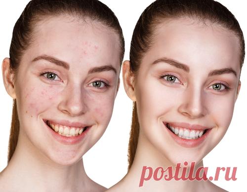 Вечерняя обработка прыщей листьями базилика и маслом эвкалипта - Полезные советы красоты